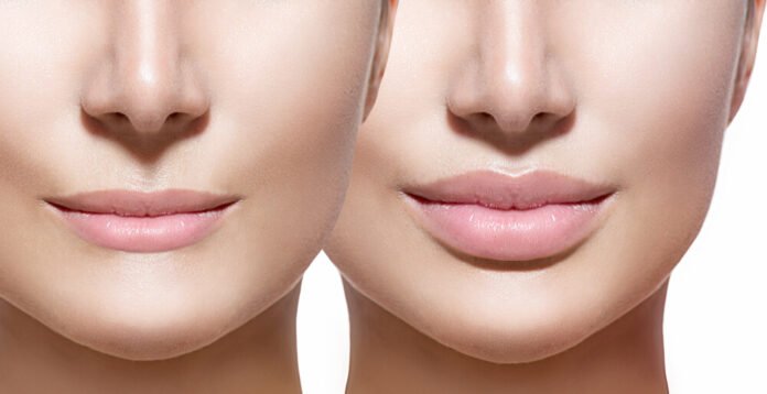 Natural Vs Dermal Fillers