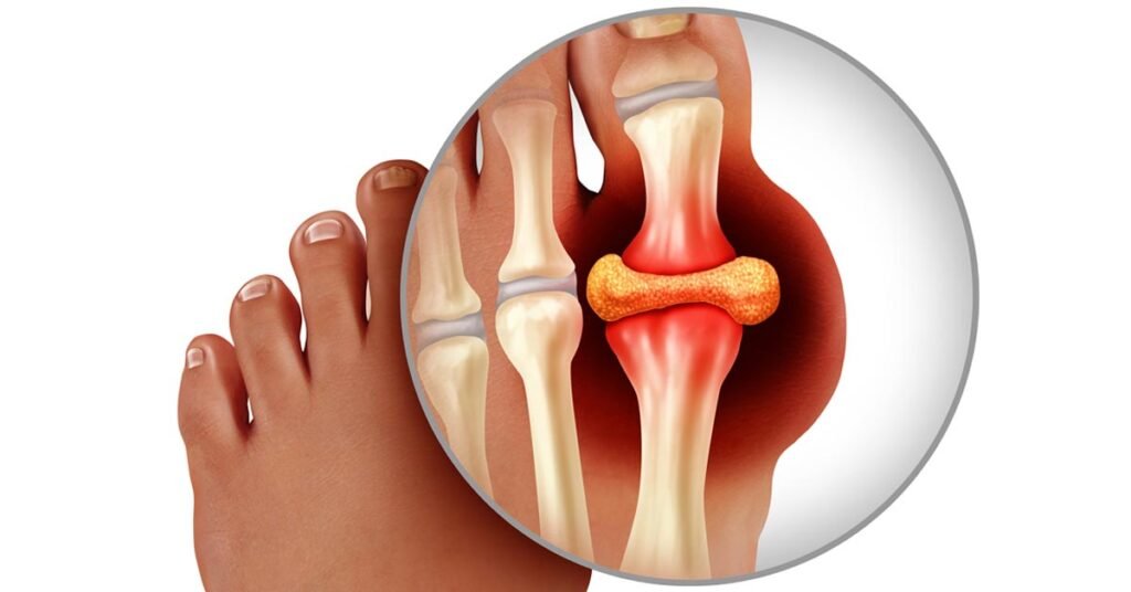 Acute Gouty Arthritis