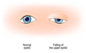 Drooping of upper eyelids