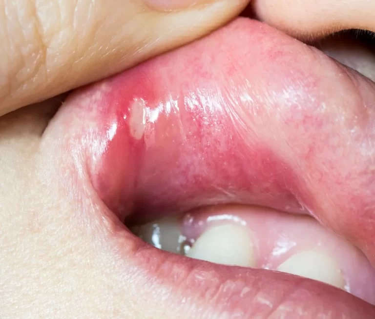 Canker Sores: How to Treat Them