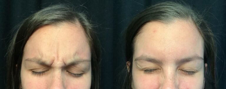 Skin Tightening Morpheus8 Before and After Pictures